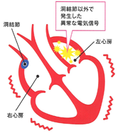 心房細動